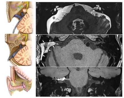 Tweetorial: MRI Of The Internal Auditory Canal, Labyrinth, And Middle Ear